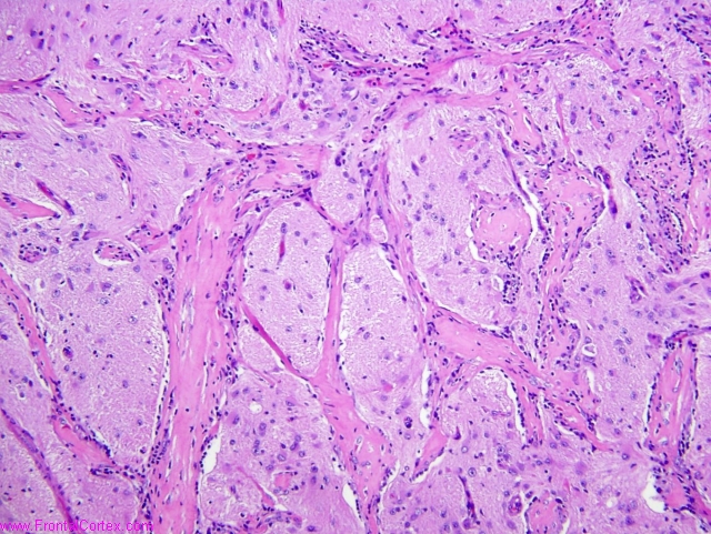 menigioangiomatosis_40x